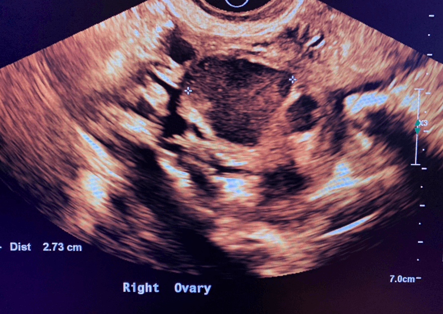 Endometrioma on the ovary