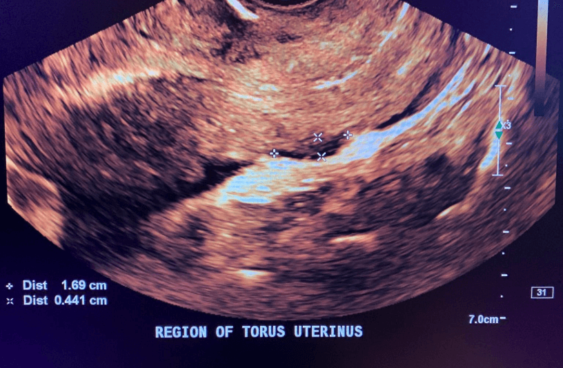 Endometriotic nodule in the pouch of Douglas