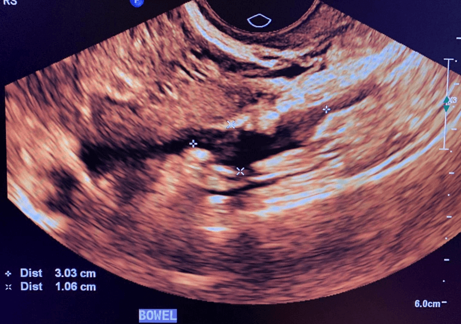 Rectosigmoid endometriotic nodule