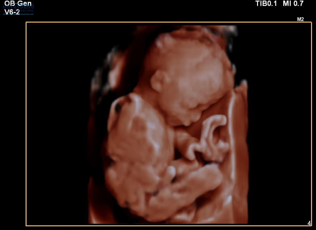 Scan of the Week: 20 Week Scan
