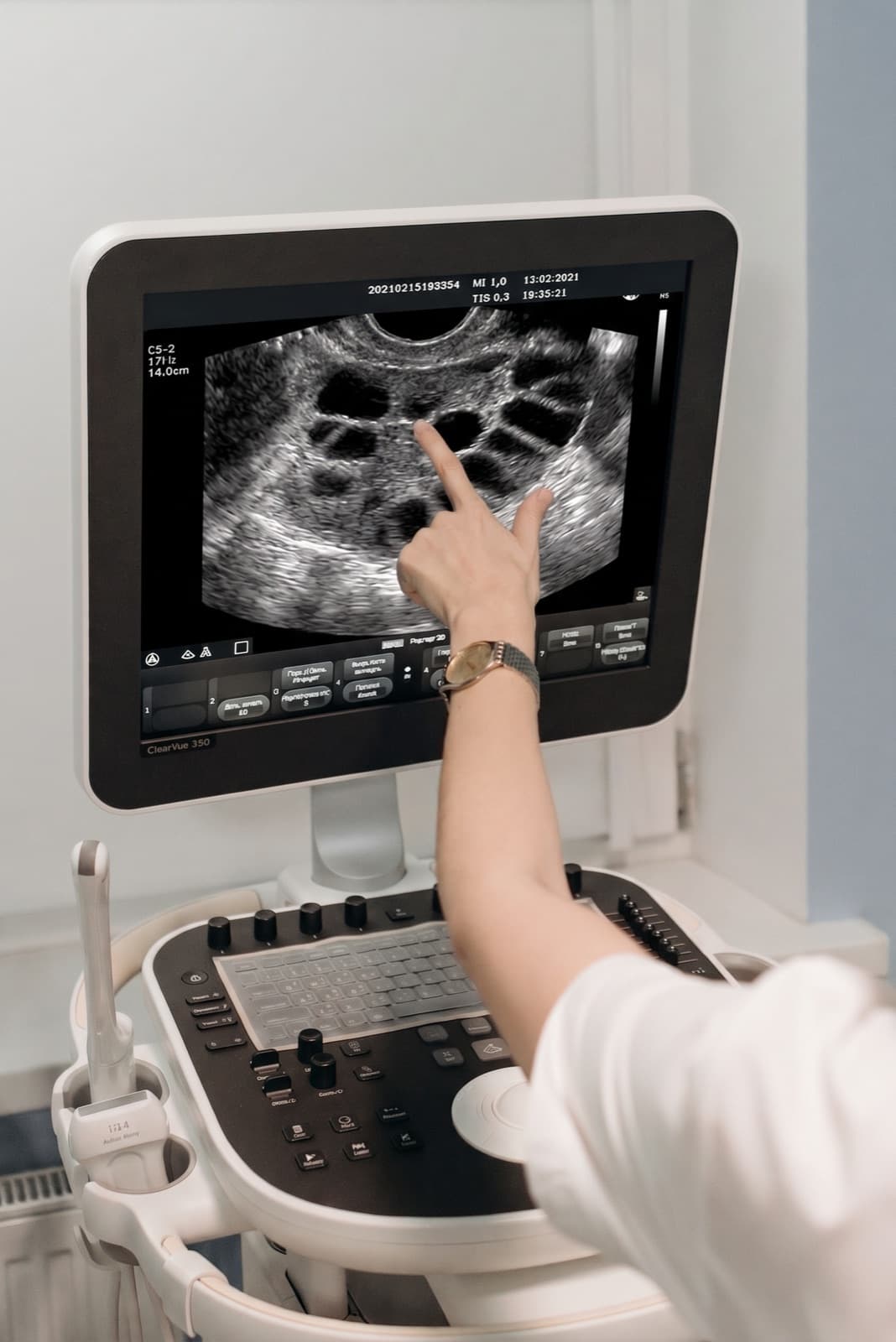 Sonographer pointing at ovarian follicles on an ultrasound monitor during a follicle tracking scan