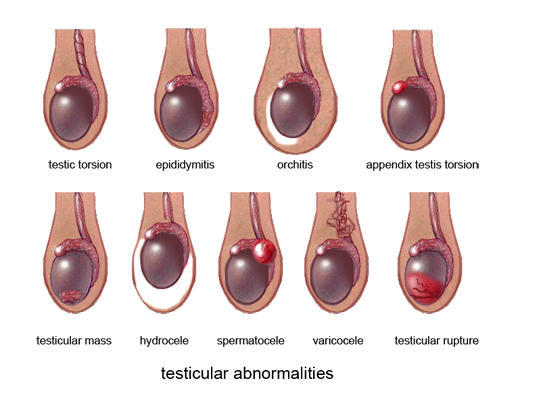 Are Testicular Cancer Lumps Round