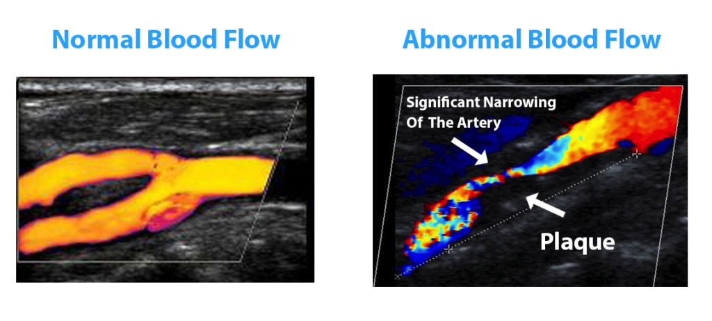 Carotid Doppler Ultrasound