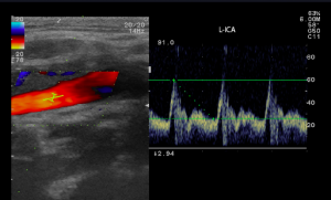 Neck Ultrasound